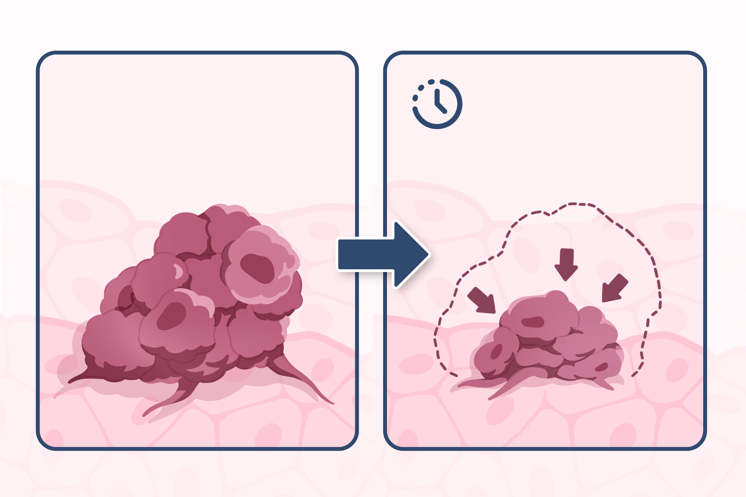 Diagram showing damaged cancer cells dying and the tumour shrinking over time.